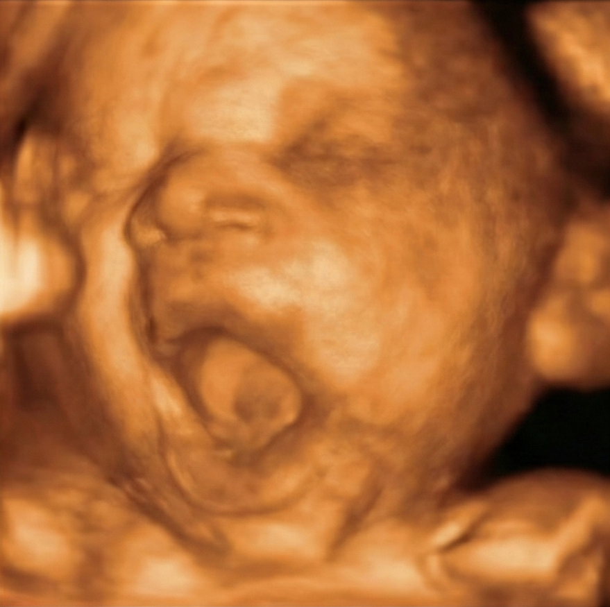 Ecografía 3D original semana 28 — antes de IA