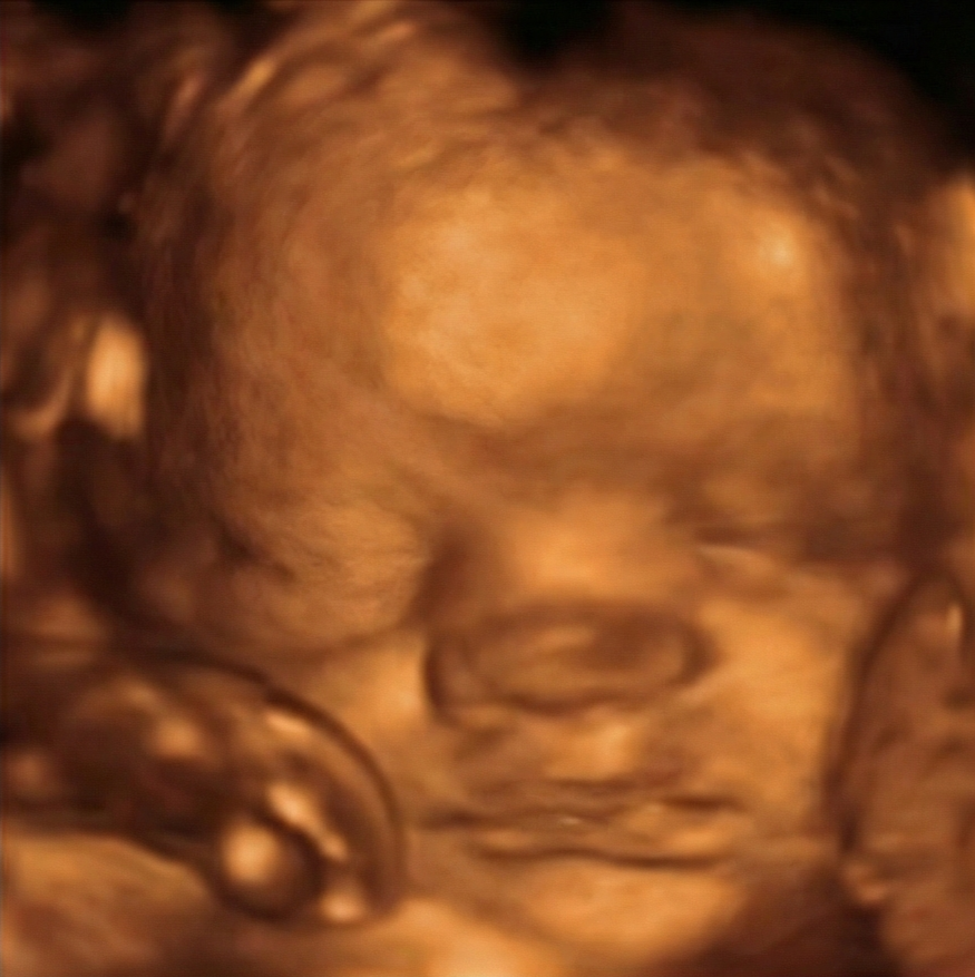 Ecografía 3D original semana 32 — antes de IA