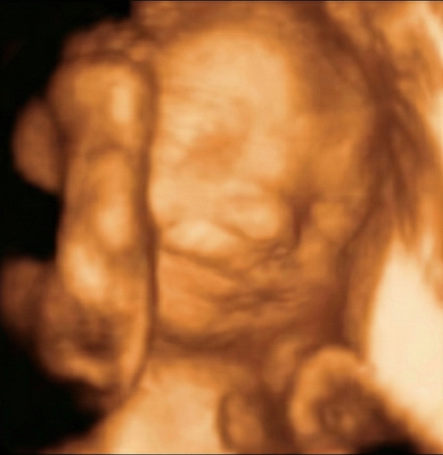 Ecografía 3D original semana 32 — antes de IA