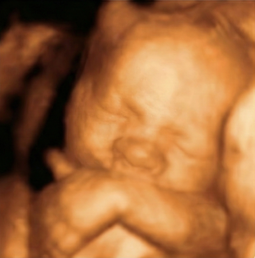 Ecografía 3D original semana 36 — antes de IA